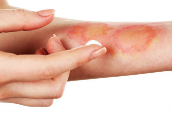 Лечение кожи после контакта с борщевиком