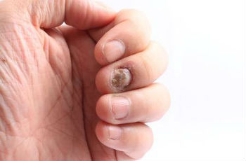 Псориатическое поражение ногтевой пластины
