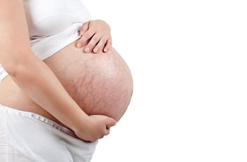 Растяжки при беременности, причины, как предотвратить, после родов