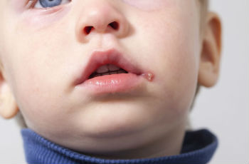 Стафилококковое повреждение кожи у ребенка