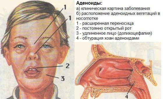 Основные признаки аденоидов, аденоидное лицо
