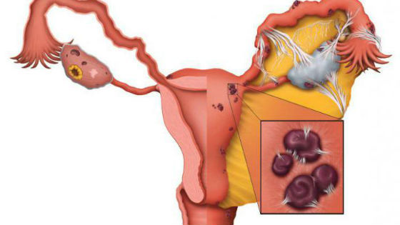 Прорастание эндометрия в соседние ткани