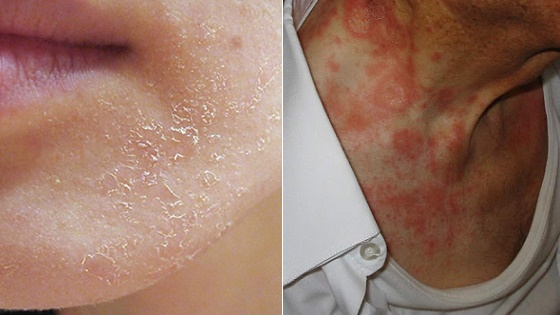 Наиболее распространенным последствием избытка аскорбиновой кислоты является аллергия