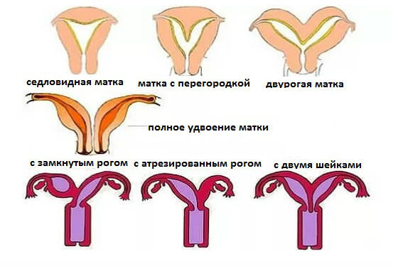 Патологии развития внутренних половых органов женщины