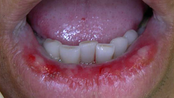 Проявления бактериального поражения полости рта