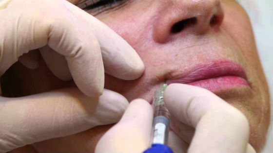 Инъекции ботокса как эффективный метод избавления от складок вокруг губ