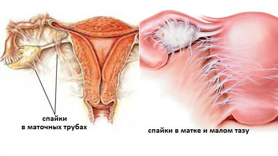 Спаечный процесс во внутренних половых органах женщины