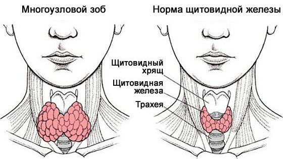 Нормальная и увеличенная щитовидка