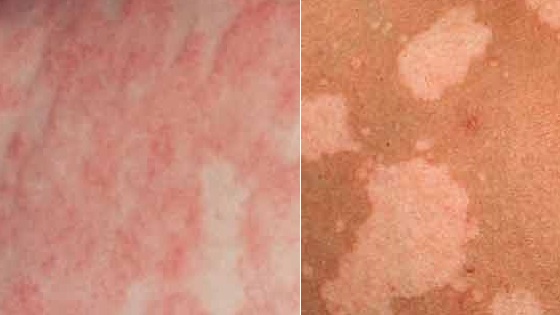 Пятна, вызванные нарушением состава микрофлоры кожи