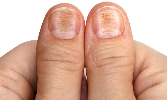 Деформация ногтей при недостатке железа в организме