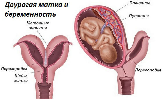 Осложнения беременности при наличии дополнительной маточной полости
