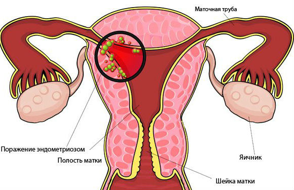 Эндометриоз в период климакса приводит к кровотечениям