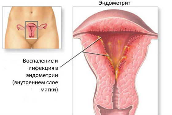 Состояние слизистой матки при эндометрите