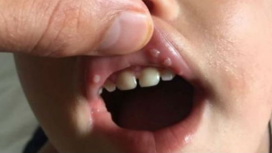 Энтеровирусный стоматит проявляется язвами во рту