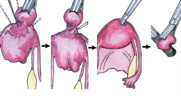 Удаление миоматозных узлов хирургическим методом