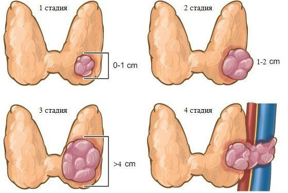 Стадии раковой опухоли щитовидки