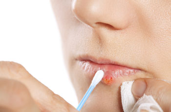 Лечение герпеса на губе антисептиком для образования корочки