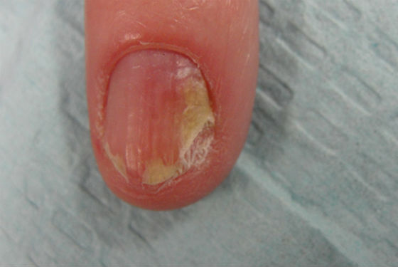 Инфекционное поражение ногтевой пластины