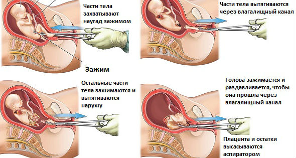 Этапы хирургического прерывания беременности