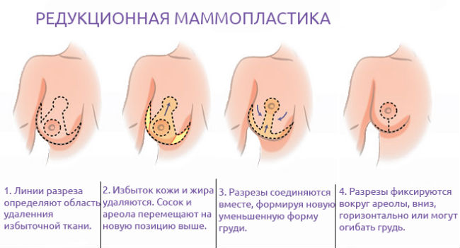 Хирургическое лечение опущения груди