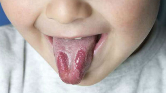 Темные пятна на языке при хроническом кандидозе во рту