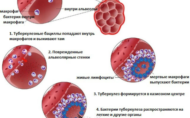 Развитие туберкулезных бактерий в организме