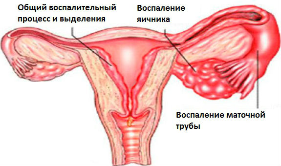 Воспаление яичника и воспаление маточной трубы