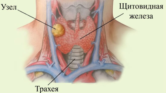 Как выглядят узловые образования в щитовидке
