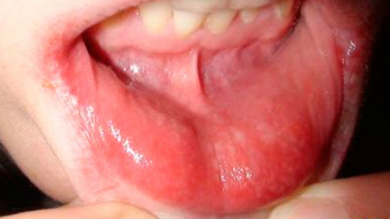Воспаление полости рта при неправильном уходе
