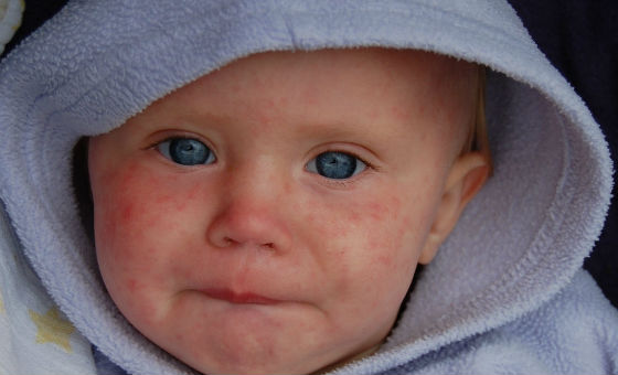 Высыпания на лице у ребенка первого года жизни