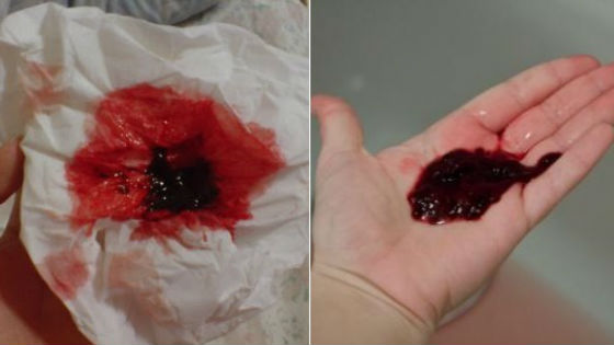 Как выглядят кровяные сгустки во время менструаций