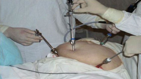 Лапароскопия как метод хирургического лечения при разрыве яичника
