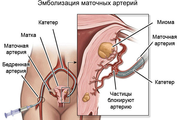 Эмболизация маточных артерий как эффективный метод лечения миомы