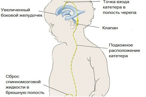 Отведение ликвора из желудочков головного мозга в брюшную полость