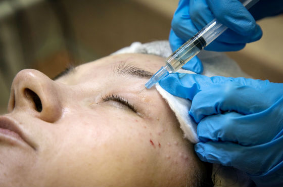 Мезотерапия для кожи вокруг глаз