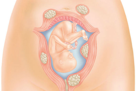 Растущая миома при беременности угрожает правильному развитию плода