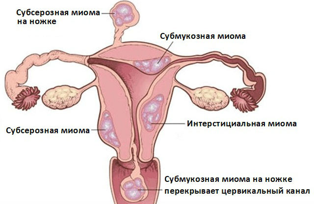 Миома может стать причиной образования сгустков во время менструации