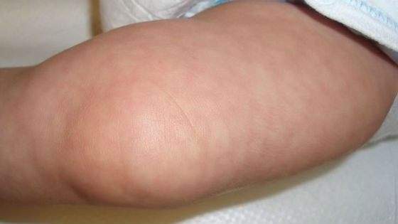 Мраморность кожи на ноге новорожденного