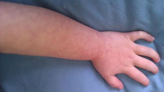Мраморность кожи на руке новорожденного