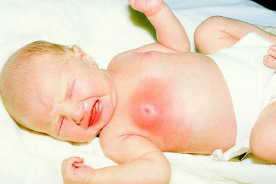 Болезненность в груди как проявления гормонального криза у новорожденного