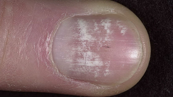 Начальная стадия псориатического поражения ногтевой пластины
