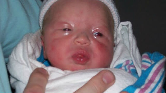 Заболевания глаз у новорожденного при врожденном токсоплазмозе