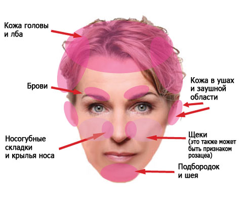 Области поражения себорейным дерматитом кожи головы и лица