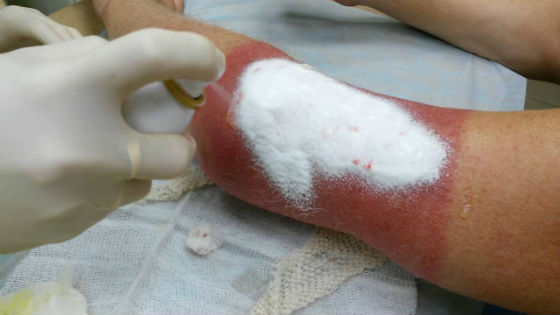 Нанесение заживляющего спрея при термическом поражении кожи