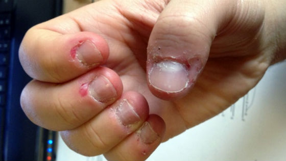 Поврежденная кожа вокруг ногтевой пластины