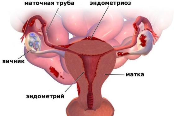 Эндометриоз вследствие гиперплазии оболочки матки