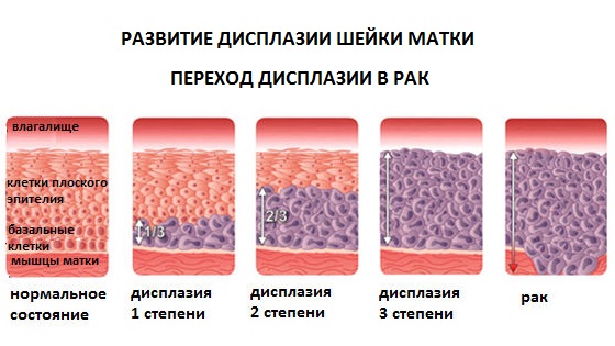 Стадии развития патологий шейки от дисплазии до раковой опухоли