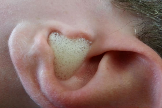 Закапывание перекиси водорода в ухо