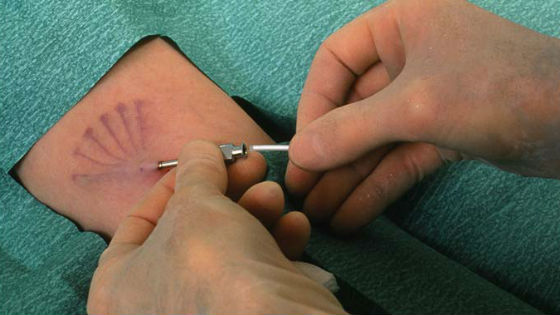 Введение подкожных имплантов в качестве методов контрацепции