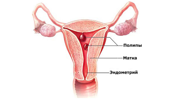 Полипы на эндометрии в матке